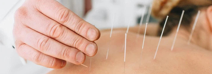 Woman Receiving Dry Needling Therapy